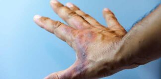 علاج ما بعد الحروق