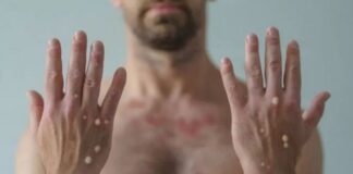 الدغيس: عقدنا اجتماعا للتأهب لمواجهة مرض جدري القرود المنتشر في الوقت الحالي