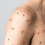 الدغيس: لم يتم تسجيل أي حالة مصابة بمرض جدري القرود في البلاد حتى اللحظة